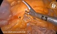 Résection D’un Adénocarcinome Jéjunal Proximal Juste En Aval Du Ligament De Treitz