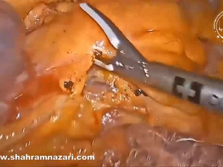 Résection D’un Adénocarcinome Jéjunal Proximal Juste En Aval Du Ligament De Treitz