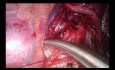 Segmentectomie pulmonaire anatomique S10 par CTVA uniportale