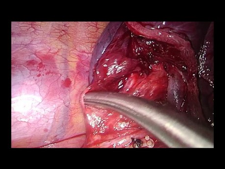 Segmentectomie pulmonaire anatomique S10 par CTVA uniportale