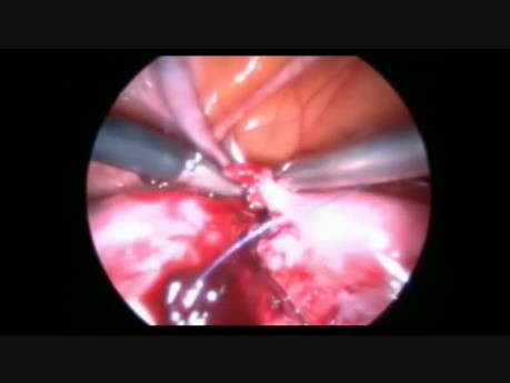 Plastie tubaire par voie laparoscopique
