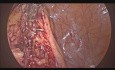 Sigmoïdectomie laparoscopique en raison de diverticulite