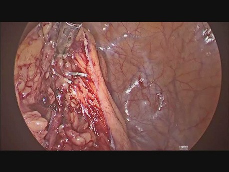 Sigmoïdectomie laparoscopique en raison de diverticulite