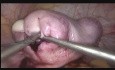 Myomectomie