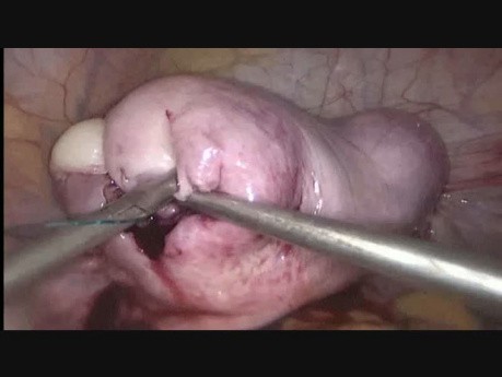 Myomectomie