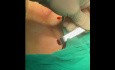 Chirurgie Thyroïdienne Endoscopique Trans-Sous-Clavière à Double abord (partie 0)
