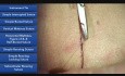 Point simple cutané - les techniques de la suture