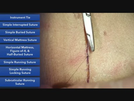 Point simple cutané - les techniques de la suture