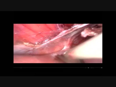 Péritonectomie Diaphragmatique