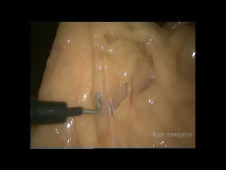 Résection antérieure basse par voie laparoscopique pour cancer du rectum