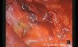 Lobectomie Supérieure Droite par Vidéo-Thoracoscopie Uniportale (Intervention montrée en entier)