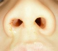 Décharge unilatérale de corps étranger nasal