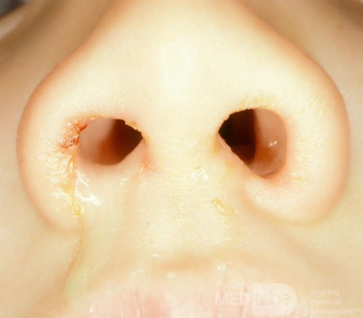 Décharge unilatérale de corps étranger nasal