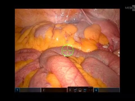 Résection Robotisée du Côlon Sigmoïde pour Diverticulite Récidivante