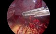 Splénéctomie Laparoscopique Suite à une Rupture Splénique Spontanée 