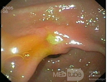 L'ulcère situés sur la petite courbure de l'estomac.