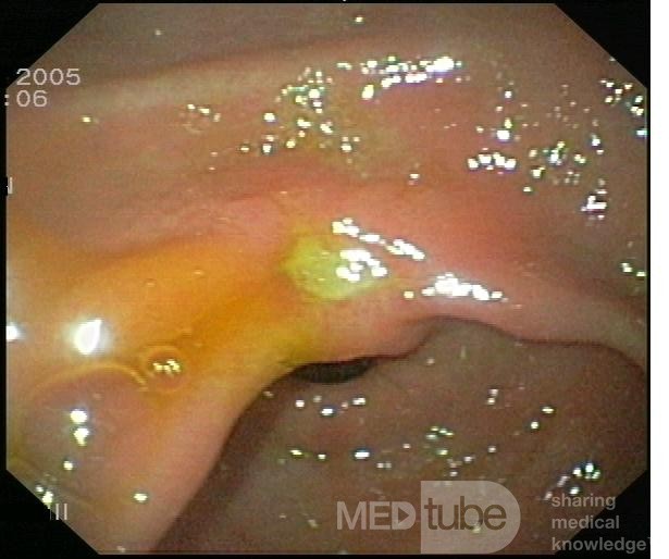 L'ulcère situés sur la petite courbure de l'estomac.