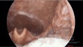 Candidose Oropharyngée