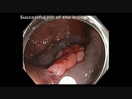 Cæcum - Lésion plane - Mucosectomie: injection-résection-coagulation