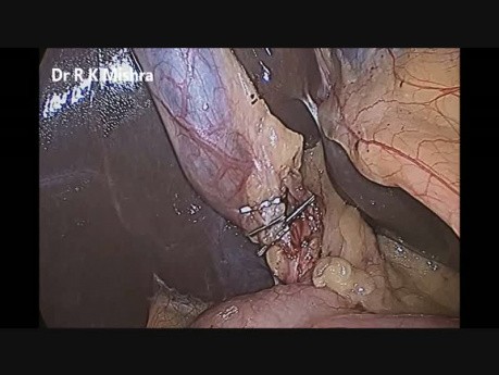 Cholécystectomie laparoscopique à deux trocarts par Dr R K Mishra