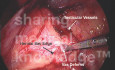 Traitement laparoscopique de hernies - l'approche TAPP