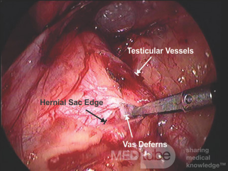 Traitement laparoscopique de hernies - l'approche TAPP