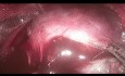 TOETVA - Thyroidectomie Trans-orale Endoscopique, Abord Vestibulaire 