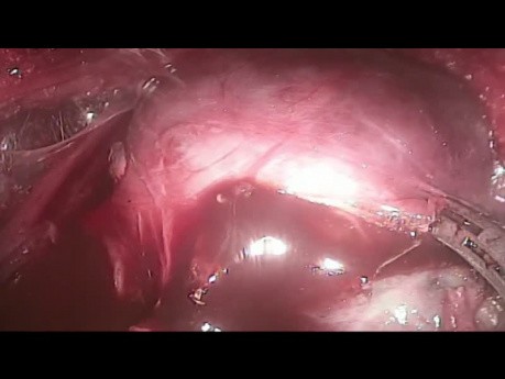 TOETVA - Thyroidectomie Trans-orale Endoscopique, Abord Vestibulaire 