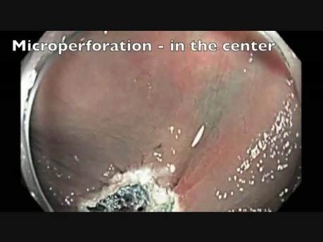 Côlon: Résection Muqueuse Endoscopique compliquée d'une perforation - partie 6