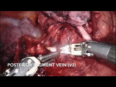 Segmentectomie S2 (par robot)