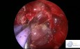 Ablation Endoscopique Intracrânienne de Neuroblastome Olfactif