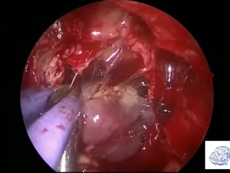 Ablation Endoscopique Intracrânienne de Neuroblastome Olfactif