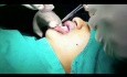 Chirurgie de réduction de volume des lèvres supérieure et inférieure
