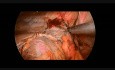 Réparation par Thoracoscopie d'une Hernie Diaphragmatique Gauche chez un garçon de 12 ans