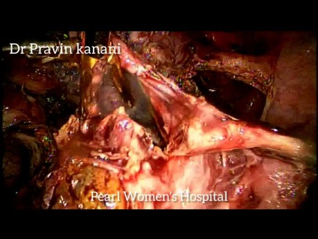 Chirurgie laparoscopique d'urgence difficile d'une grossesse extra-utérine rompue avec kyste au chocolat et myomectomie