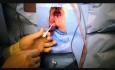 Traitement d'une fistule anale par laser