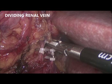 Néphrectomie radicale laparoscopique droite