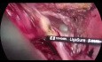 Résection multiviscérale laparoscopique pour cancer sigmoïde cT4 avancé