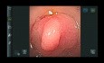 Gastroscope à usage unique ou réutilisable: Essai prospectif randomisé de non infériorité