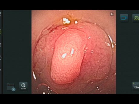 Gastroscope à usage unique ou réutilisable: Essai prospectif randomisé de non infériorité