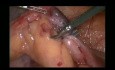 Mini appendicectomie