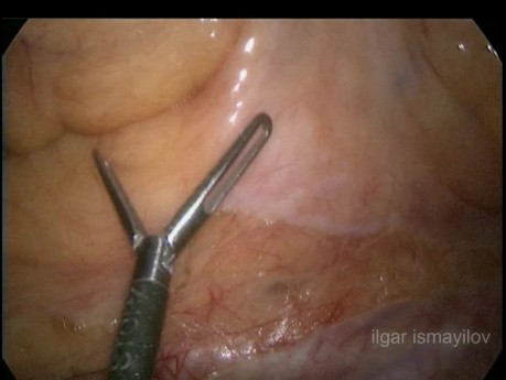 Exérèse totale du mésorectum par voie laparoscopique avec une résection intersphinctérienne partielle pour le cancer de la partie distale du rectum