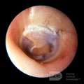 Tube de ventilation bleu dans l'oreille moyenne