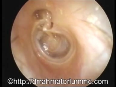 Poche de Rétraction Atticale avec Résorption du Scutum