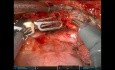 Résection de la Bronche Principale Gauche et Deuxième Reconstruction de la Carène pour Tumeur Carcinoïde (URATS)