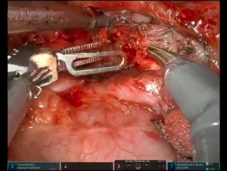 Résection de la Bronche Principale Gauche et Deuxième Reconstruction de la Carène pour Tumeur Carcinoïde (URATS)
