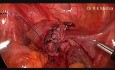 Cœlioscopie: Myomectomie + Kystectomie ovarienne + Cholécystectomie (chez la même patiente)