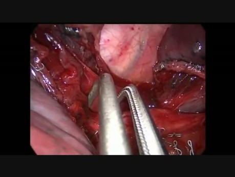 Segmentectomie du segment postéro-basal S10 ( droit ) en utilisant la méthode CTVA-U. 