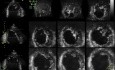 La non-compaction ventriculaire gauche (NCVG)- L'échocardiographie vidéo n ° 2