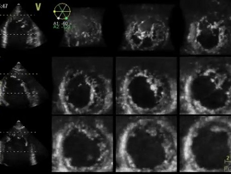 La non-compaction ventriculaire gauche (NCVG)- L'échocardiographie vidéo n ° 2